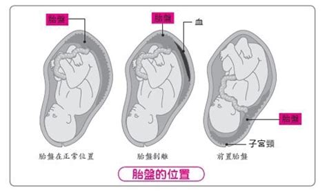 胎盤剝離方式